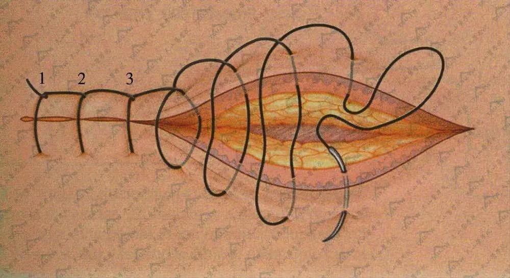 伤口缝合留疤还是不缝合留疤,可吸收的缝合线有疤痕吗