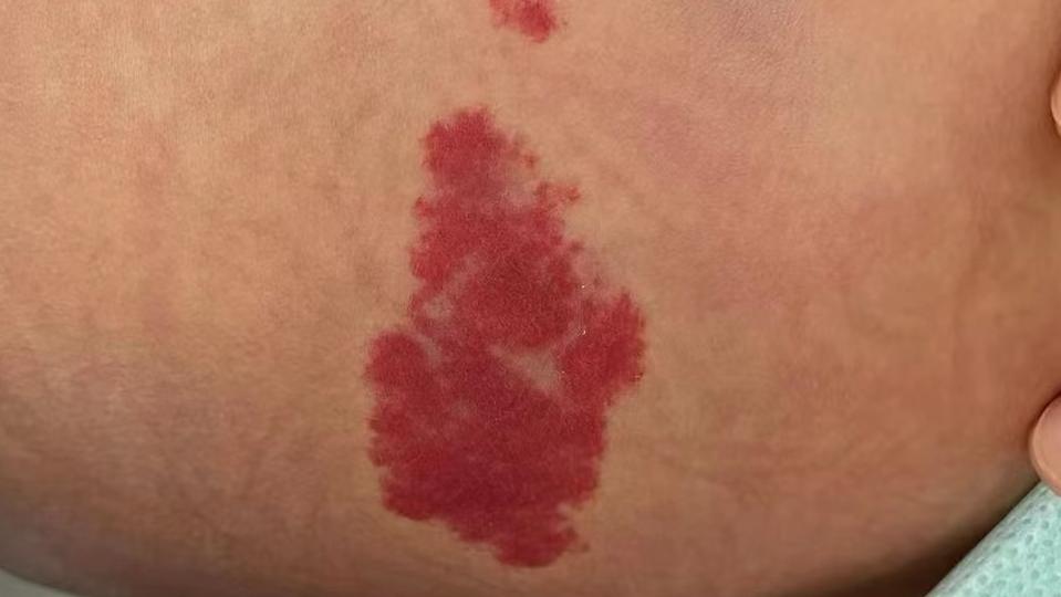 小孩胎记长肉瘤,小孩身上一块黑色胎记越长越大