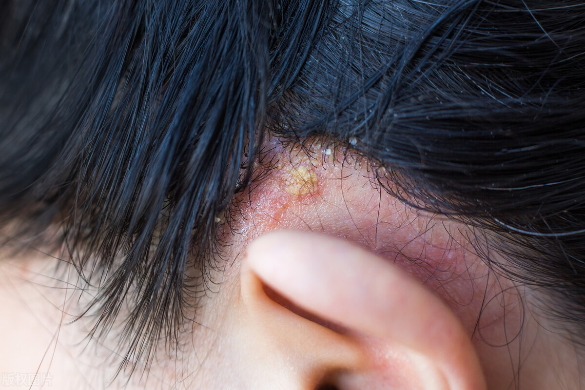 米诺地尔为什么可以治疗脱发,米诺地尔治脱发副作用