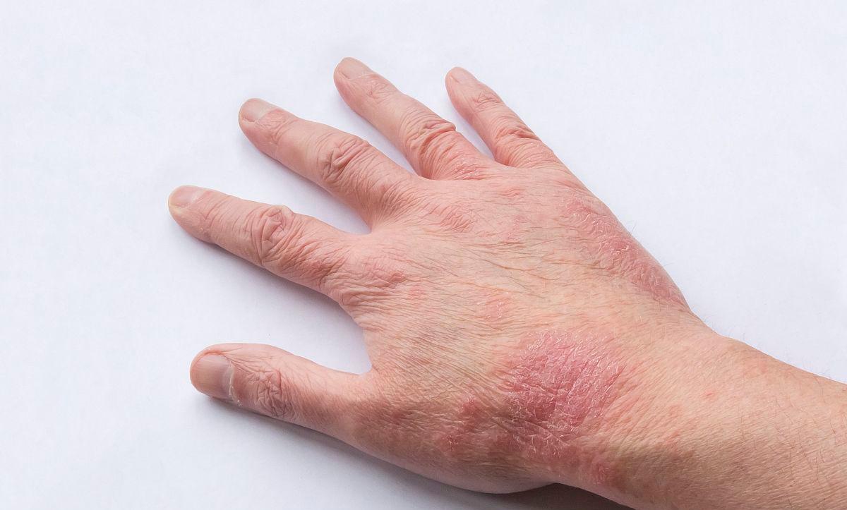 湿疹很痒挠破了是血咋治,湿疹反复挠皮肤变硬