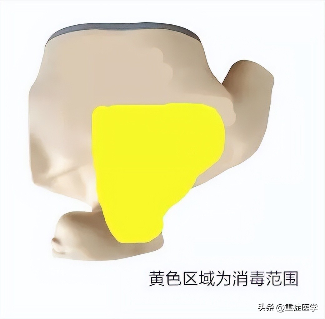 保姆级深静脉穿刺全攻略，建议收藏！