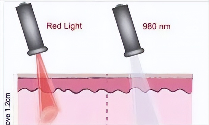 光动力治疗癌症是真的吗,光动力能治疗癌症吗