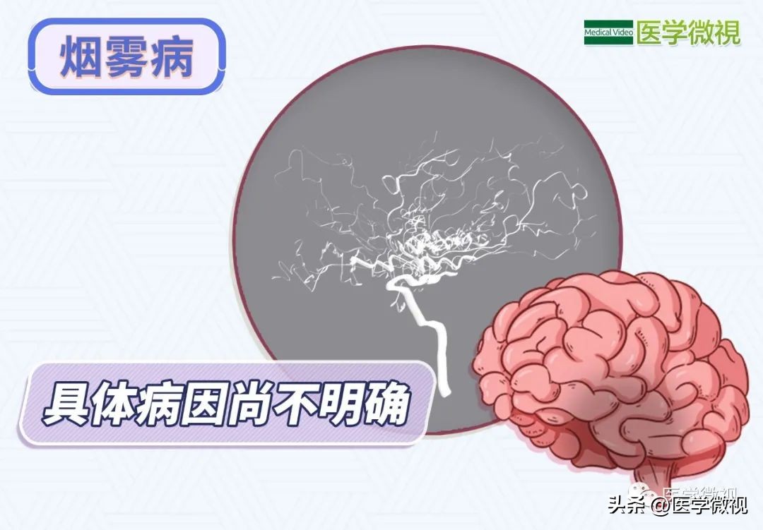 痴呆老人走失完整版,痴呆老人走失多久判定死亡