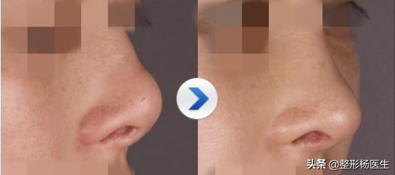 假体隆鼻取出假体多久可以恢复,假体隆鼻只简单放一个假体可以吗