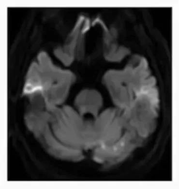 缺血性卒中治疗原则,缺血性卒中病因分型