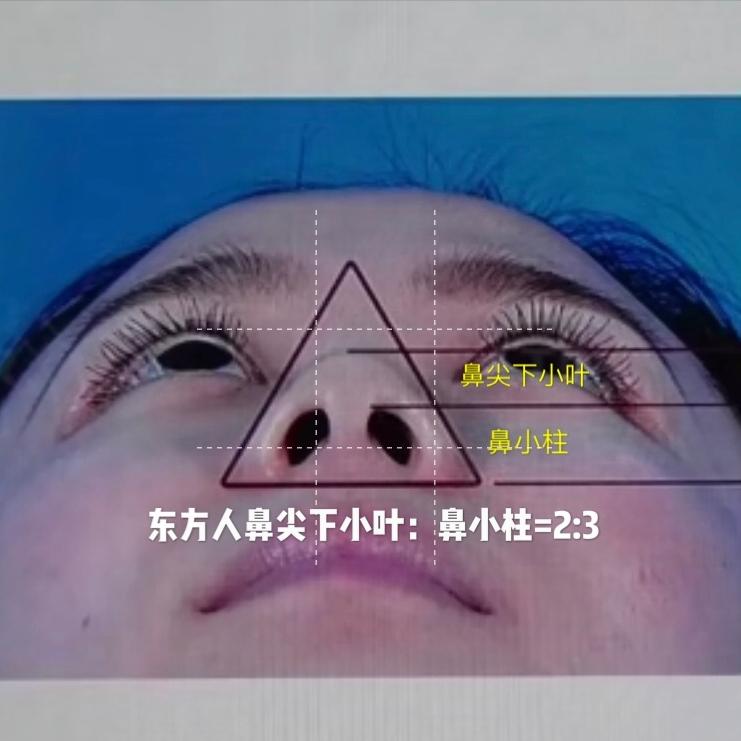 隆鼻以后鼻孔外露算是失败吗,露鼻孔的鼻子怎么隆鼻