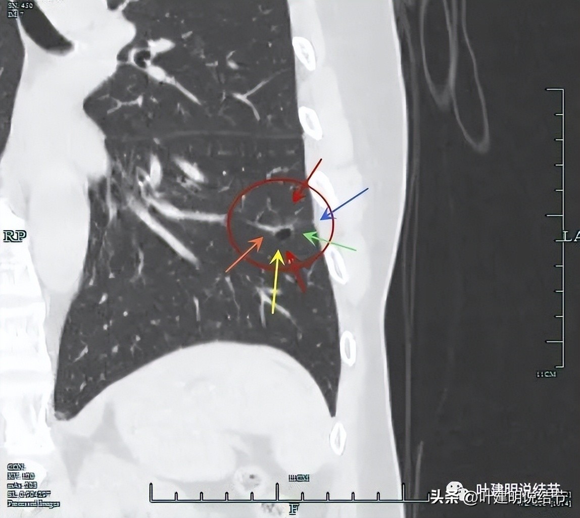 辽宁省肺结节手术哪家医院好,辽宁肺结节手术医院