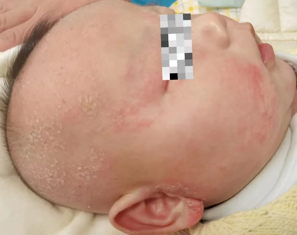 【解惑】孩子阳康1个月，皮疹咋还不消？