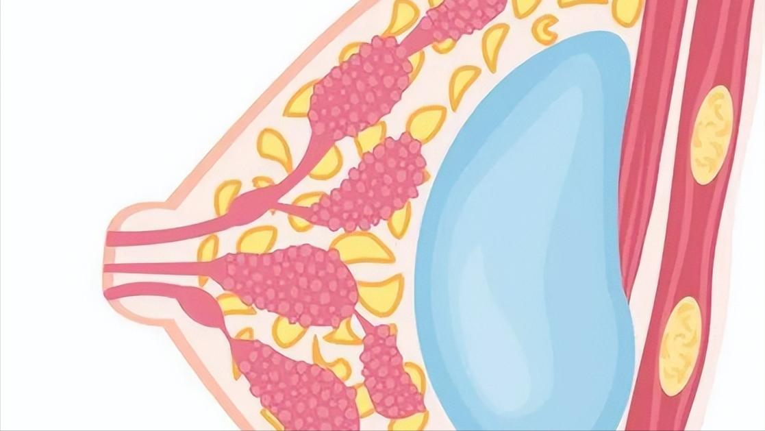 乳腺纤维瘤和乳腺囊肿的临床表现,乳腺纤维瘤手术后又长了会癌变吗