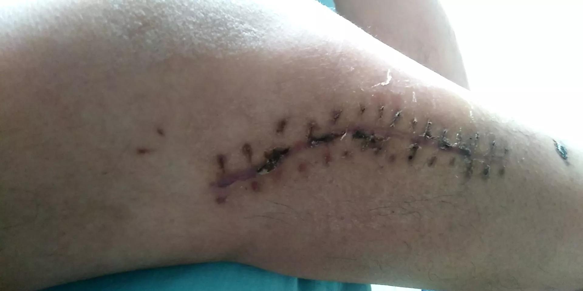 拆了石膏要怎么按摩康复,手掌拆石膏后如何康复训练