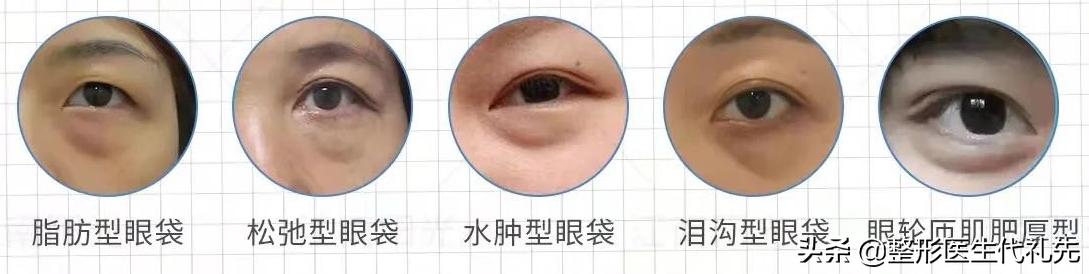 皮肤松弛型的眼袋是不是假性眼袋,眼袋上的小细纹是怎样形成的