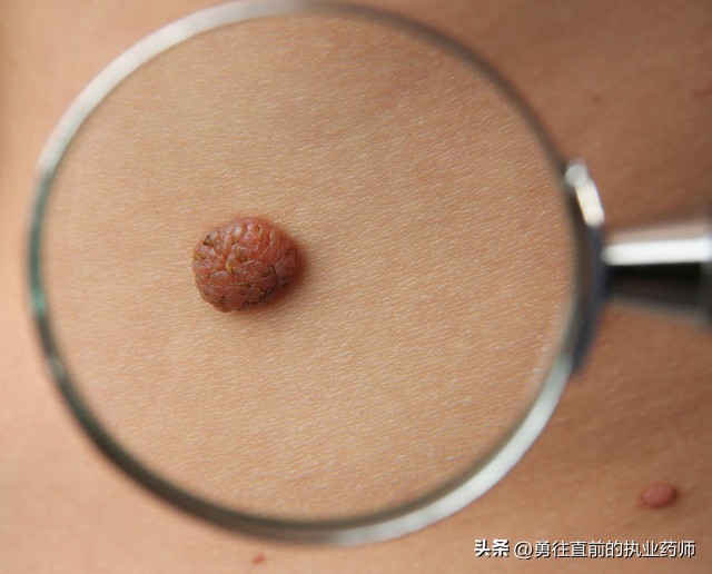皮肤上的痔疮,已癌变的黑痣咋办