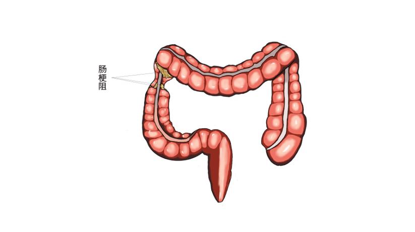 化痰散结，这几味虫类药材，助你“吃掉”肠息肉