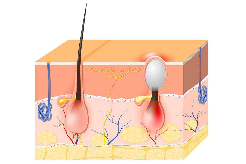 头皮总是长疙瘩或脓包是什么原因,头皮反复长疖肿起脓包