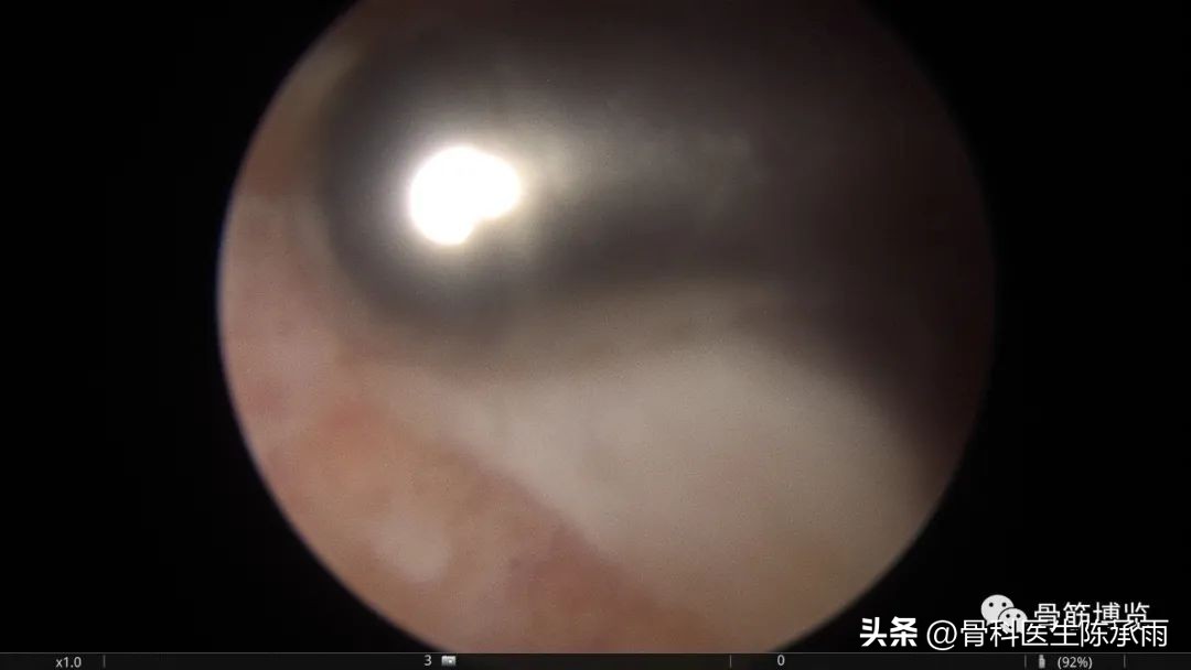 化脓性关节炎的穿刺引流治疗,关节炎镜下治疗