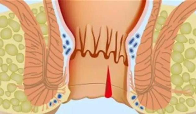 警惕肛裂带来的危害,肛裂为什么以年轻女性为主