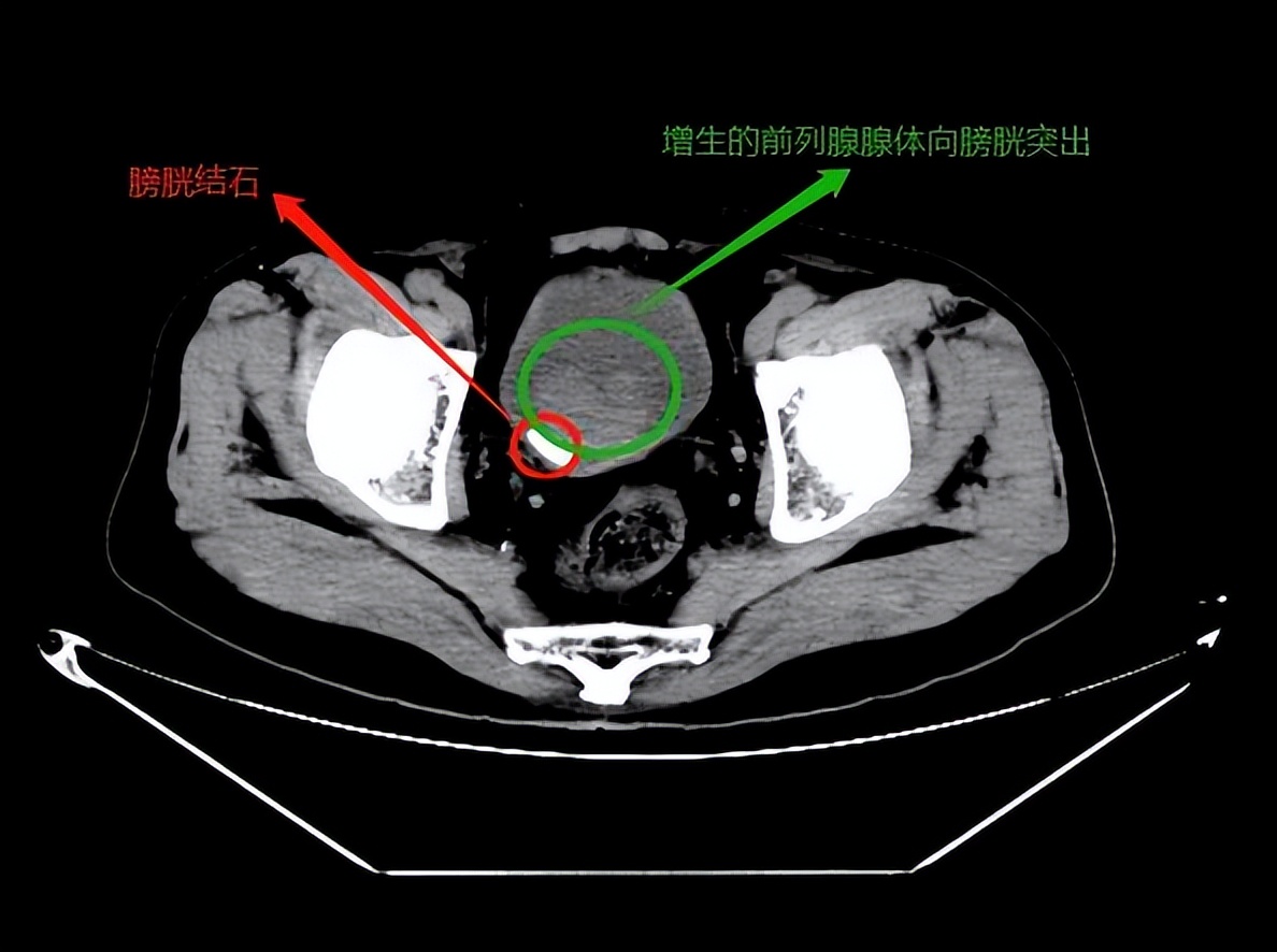 尿频尿急真的看不好吗,尿频尿急夜尿多千万别轻视