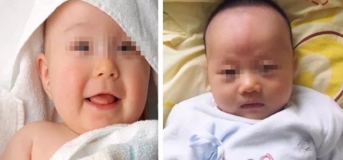 法令纹泛红暗沉做什么医美,法令纹早睡早起消除得了吗