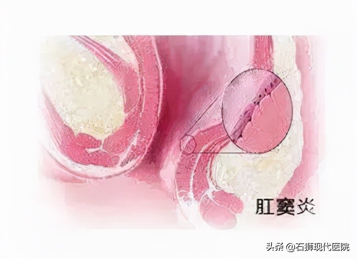 大便时肛门疼痛怎么治疗,大便肛门疼痛用什么药好得快