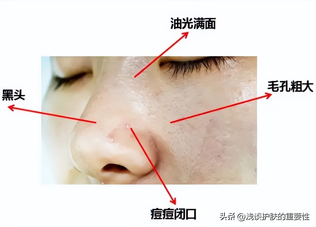 怎么有效的去除痘痘预防痘痘,因痘痘而烦恼