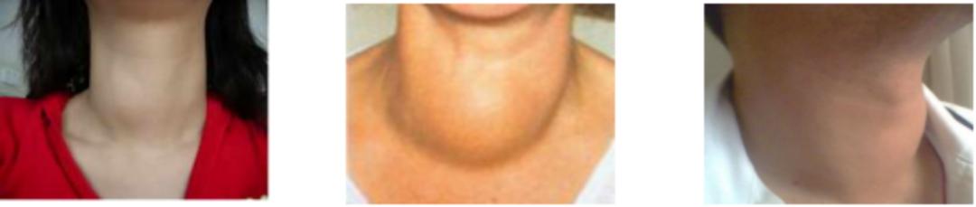 世界甲状腺知识宣传周宣传视频,世界卫生组织甲状腺结节