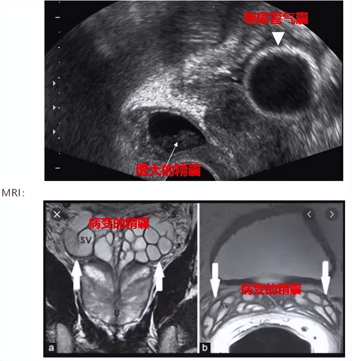 出现血精能自愈吗,出现血精能自愈吗无其他症状