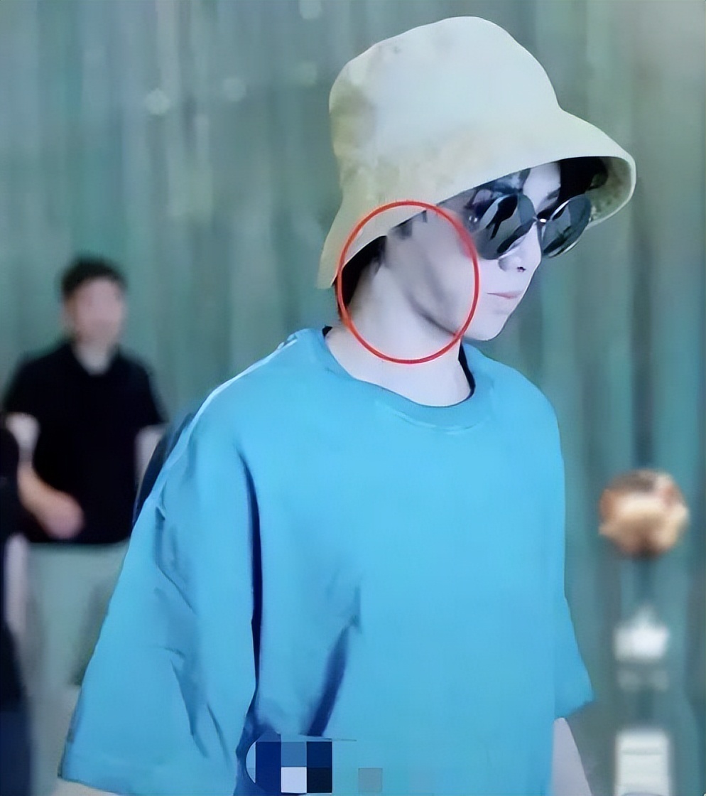 华晨宇削下颌骨的后果,华晨宇下颌骨内推