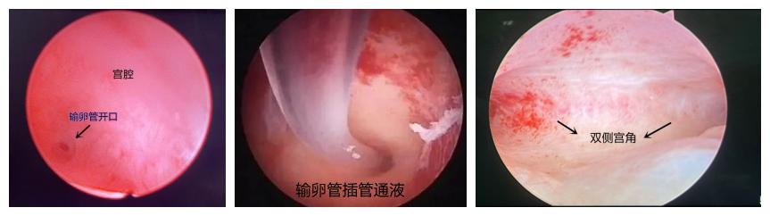 海慈妇二科宫、腹腔镜微创技术助女性收获“好孕”