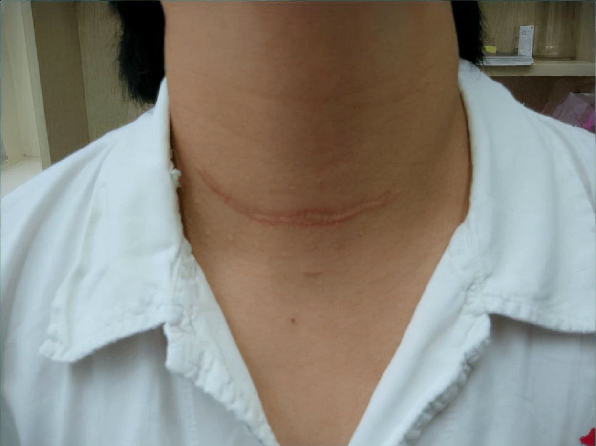 甲亢甲状腺肿大推荐什么中药,甲亢复发吃中药有效吗