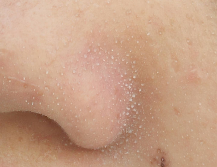 美容院清洁黑头会让毛孔变大吗,黑头拔了毛孔变大会自己愈合吗