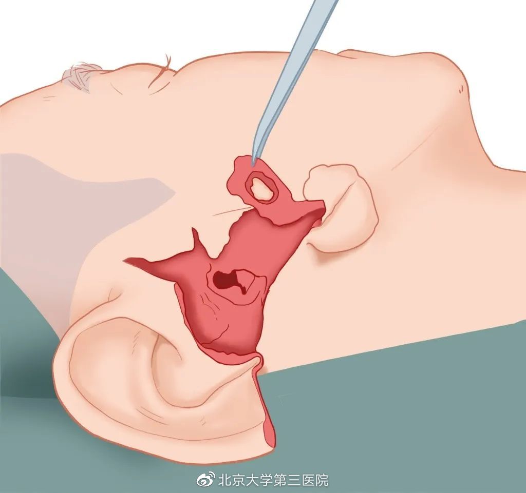 意外留疤怎么安慰,眉尾意外受伤留疤好不好