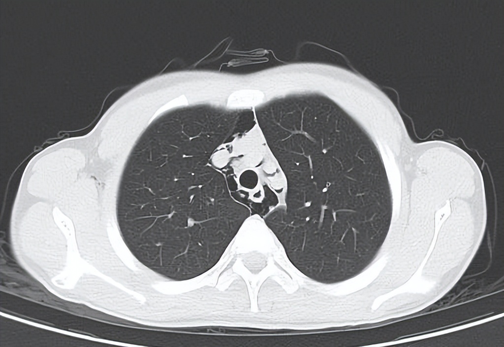 急性咽炎医生建议住院,咽炎有必要去医院急诊看吗
