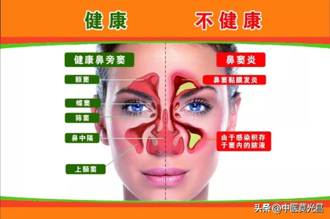 介绍一下西医关于鼻炎的治疗方案,慢性鼻炎怎么用中医治好