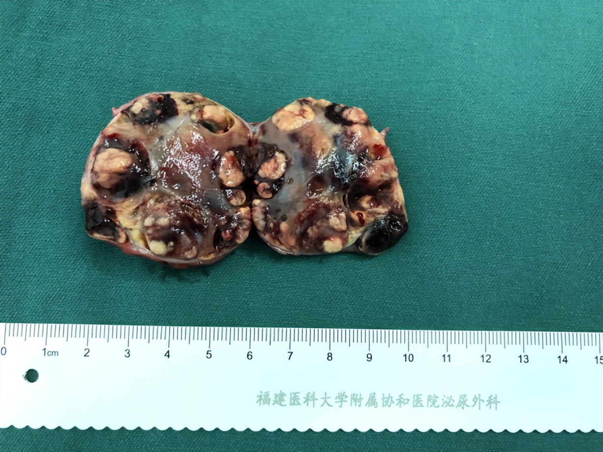 【协和医疗】高难度！泌尿外科朱绍兴教授团队高超“组合拳”完成肾肿瘤保肾手术