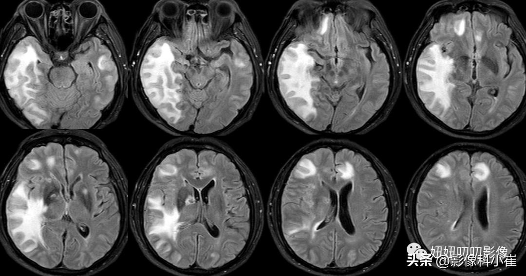 脑部肿瘤疾病有哪些,脑部有病变但是不是肿瘤