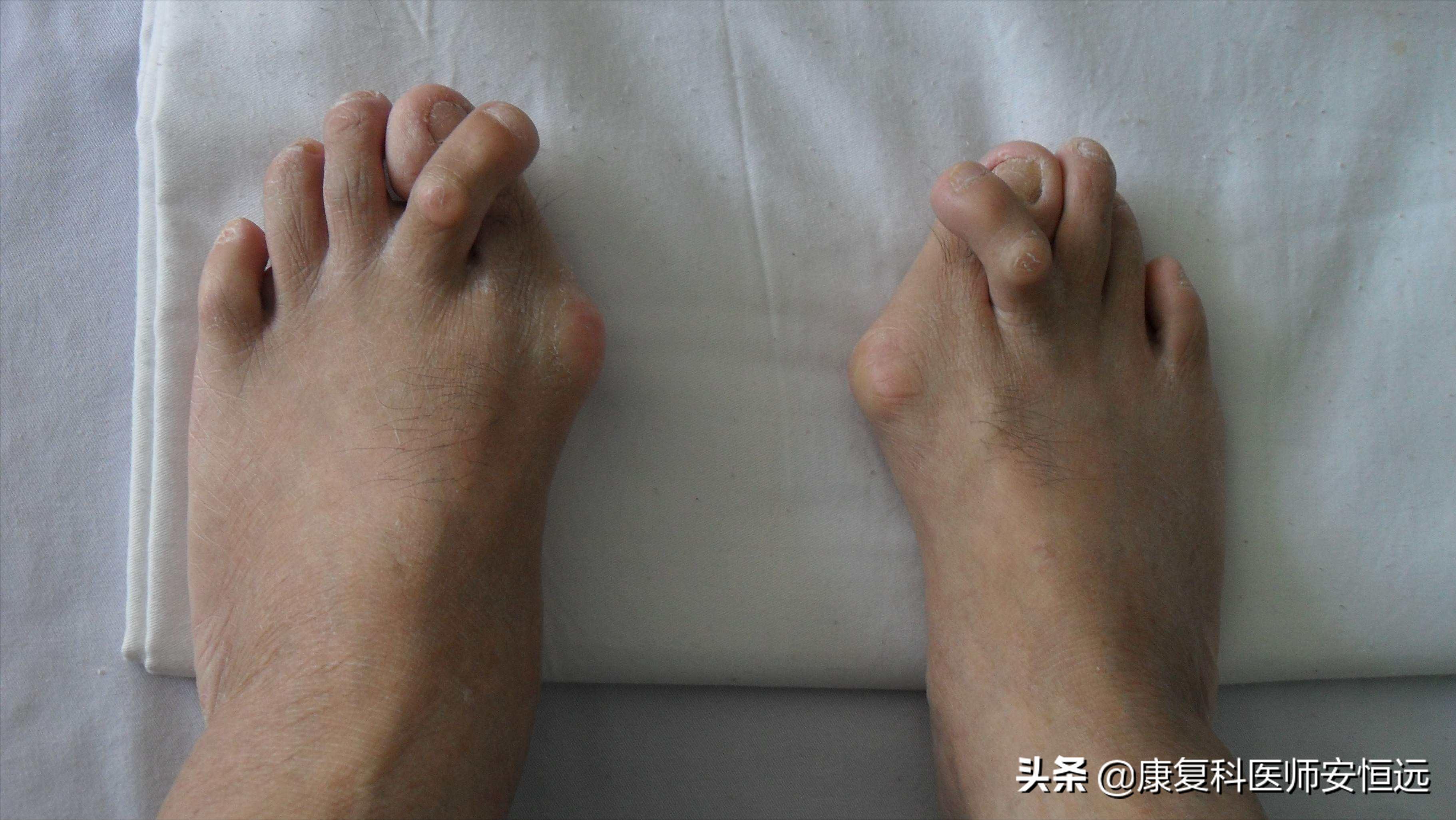 脚底板爱发烫是什么原因,脚底板生茧很疼怎么回事