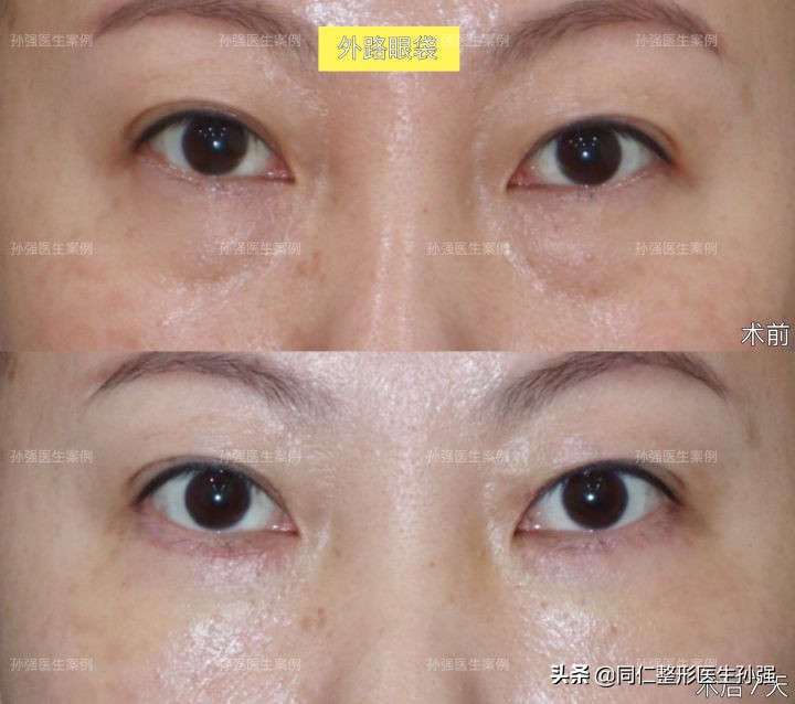 北京医院治眼袋,北京治疗眼袋好的方法