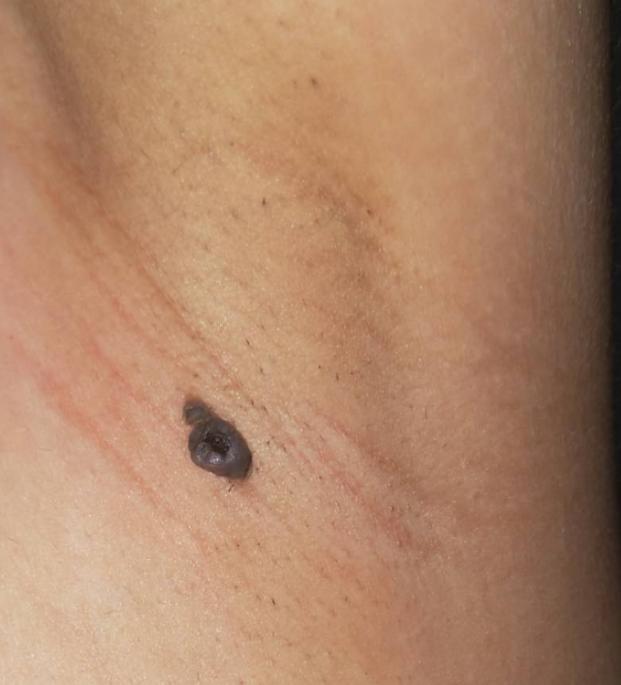 长在身体什么部位的痣容易癌变,脖子突然长痣是癌症的症状