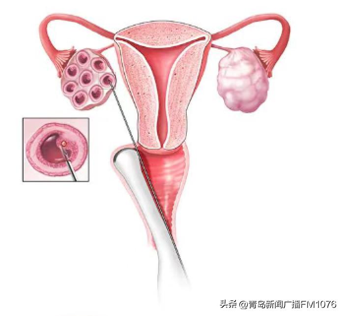 揭秘试管婴儿孕育全过程,试管婴儿诞生原理