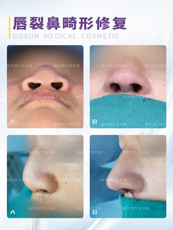 唇裂先牙齿矫正还是鼻畸形先矫正,唇裂畸形的手术修复