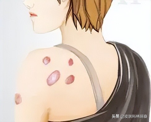 疤痕疙瘩不断的长怎么办,疤痕疙瘩不停增长怎么办