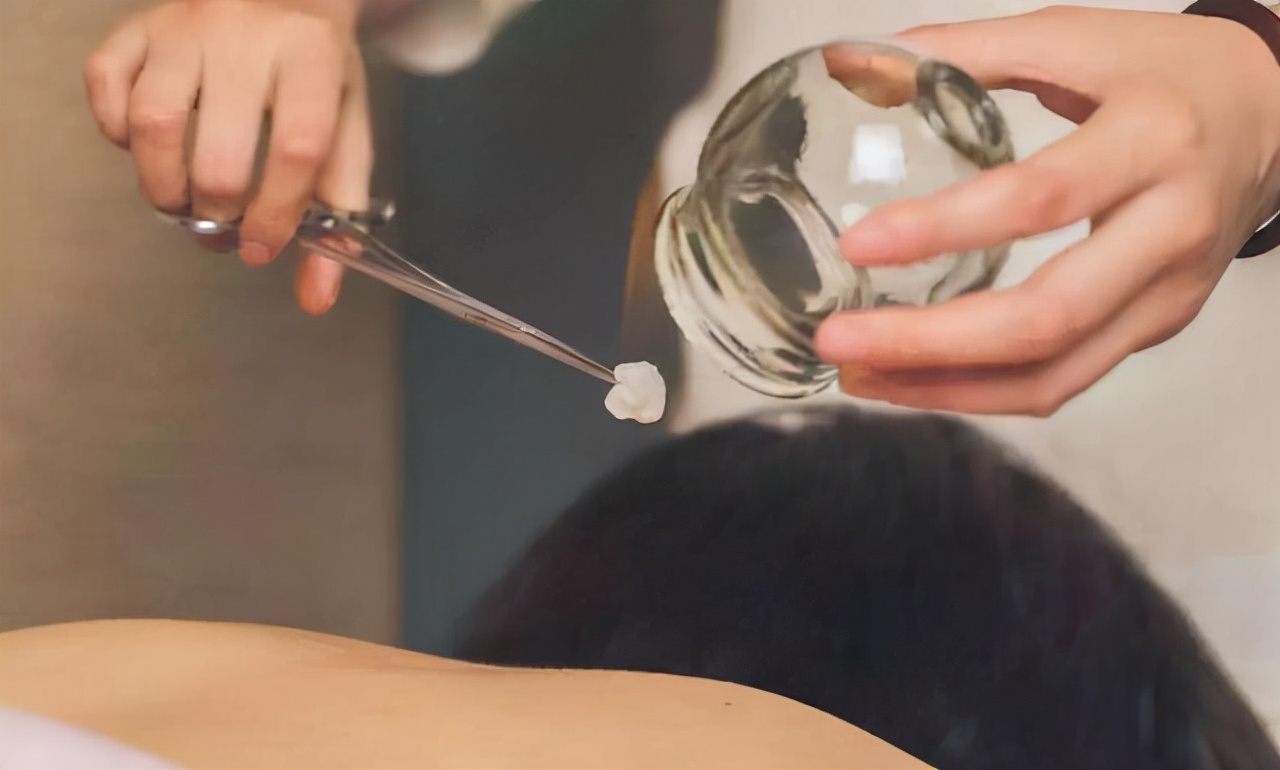 拔火罐后背吸出来的瘀血,拔火罐吸出的瘀血是真的吗