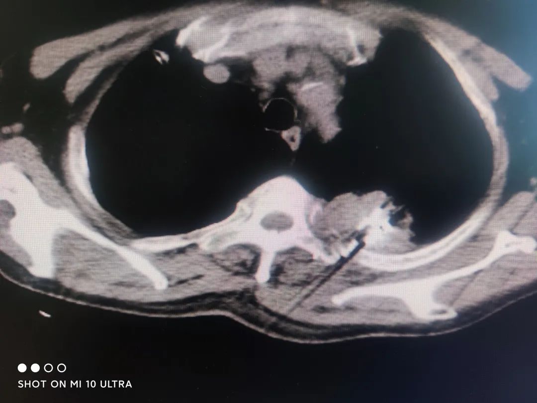 碘125适合多大肿瘤,四川有碘125粒子治疗吗