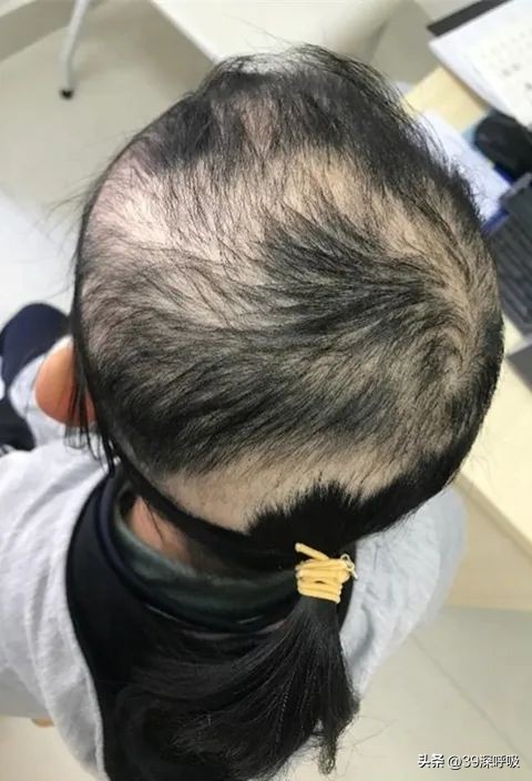 十岁孩子得了拔毛癖,孩子得了拔毛癖我该怎么办