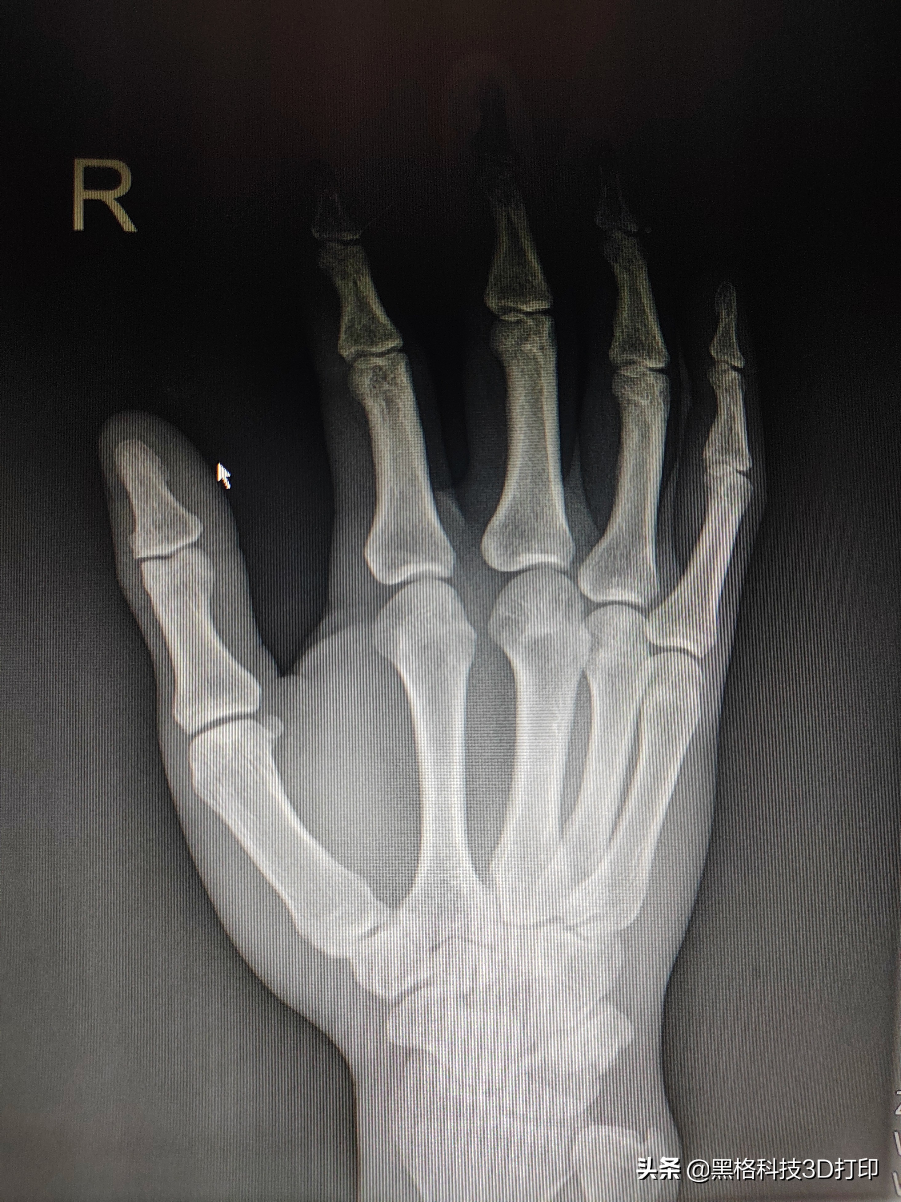 打石膏后为什么会出现瘙痒,打石膏后皮肤变黑怎么办