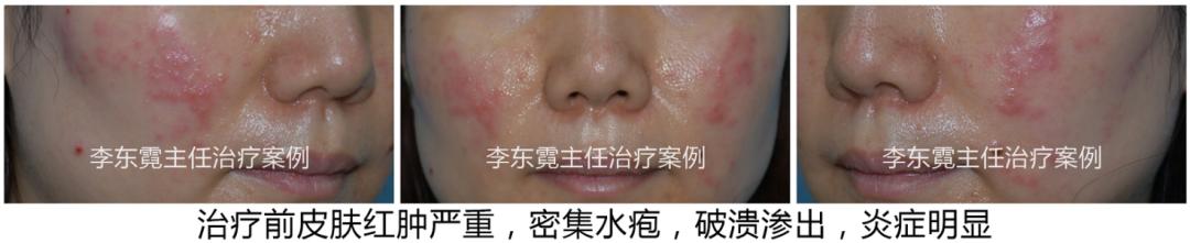 中年妇女面部色斑爆发怎样消除,女性色斑的最佳治疗方法