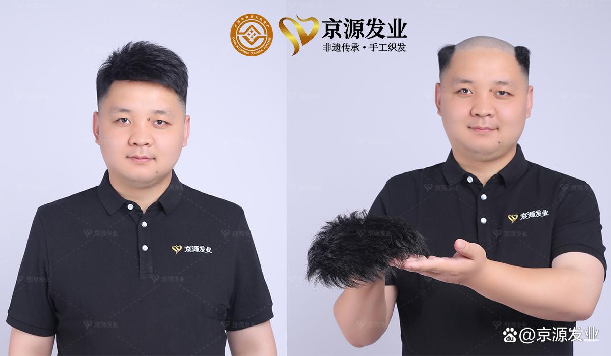 京源织发补发假发定制,头顶补发片男士