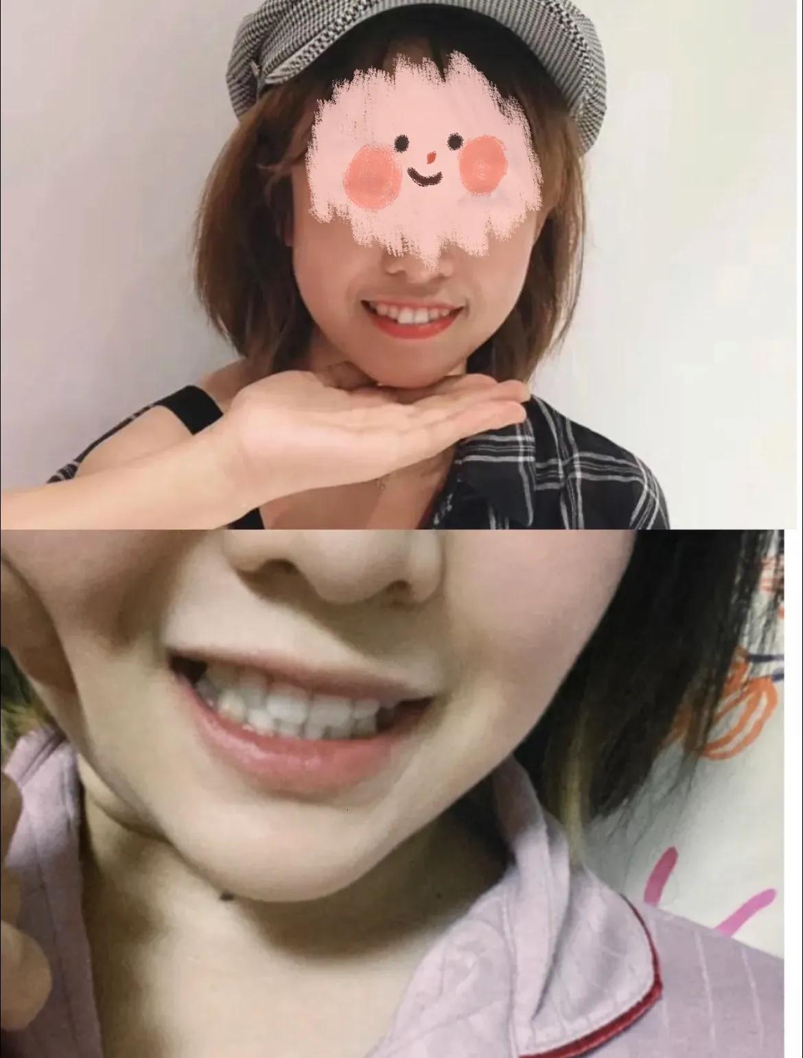 隐适美牙齿矫正有多暴利,北京牙齿矫正隐适美