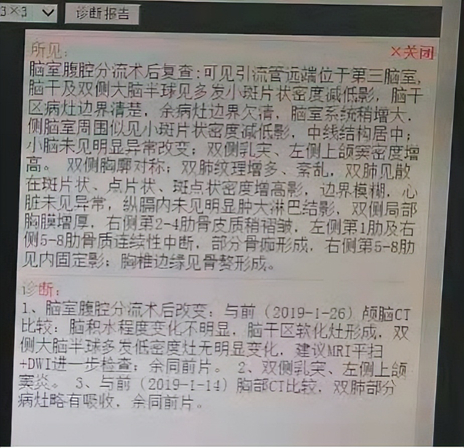 脑积水高热昏迷呕吐,脑积水病人会引起恶心呕吐吗