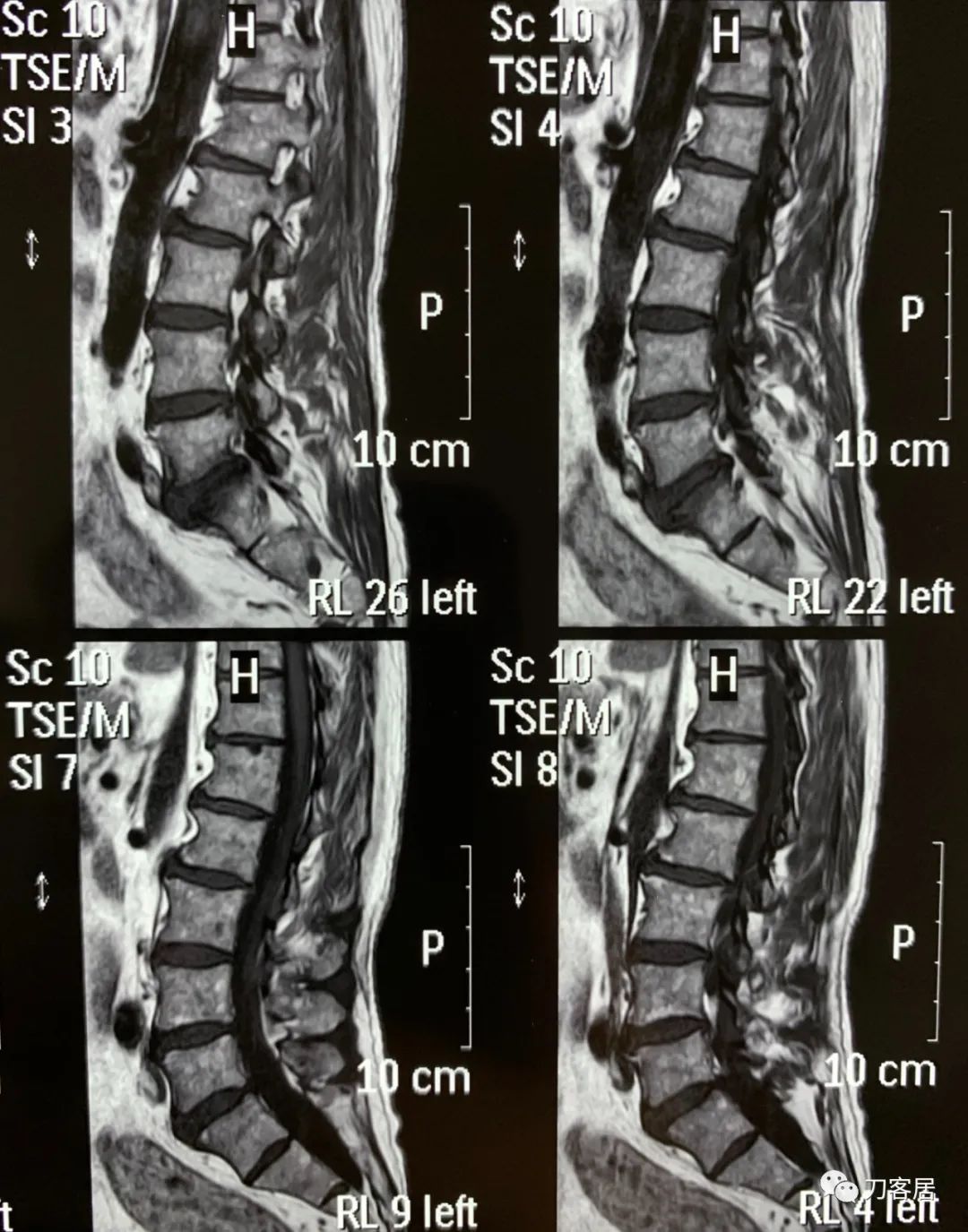 右手拇指间歇性麻木，颈椎病，颈椎失稳的保守治疗